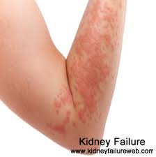 Kidney Failure And Body Rash