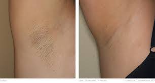 For example, with hair lasers, those with darker skin tones may. Before And After Underarm Laser Hair Removal Laser Hair Removal Laser Hair Hair Removal