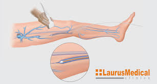 Tratamentul a esuat in cazul a 660 de pacienti, cu paralizii grave. Tratament Varice Laser Laurusmedical Hemoroizi Varice Dermatologie Gastroenterologie