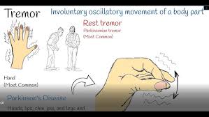 Image result for Rest Tremor