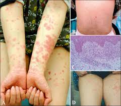 Image result for pruritic urticarial papules and plaques of pregnancy