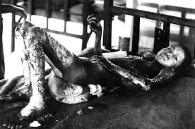 Image result for who got directly affected by the atomic warfare
