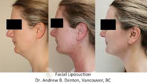 Take a look at this patient's facial liposuction results. First photo is  the before, second photo is 1 day post-op, last photo is 7 days post-op.