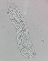 Image result for Urinary Cast