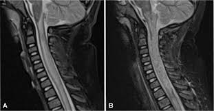 If the brain mri shows lesions. Transverse Myelitis In A Child With Covid 19 Pediatric Neurology