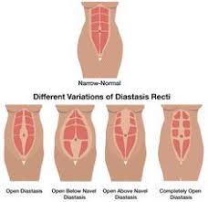 The Complete Guide To Getting Rid Of Diastasis Recti Diary Of A Fit Mommy Diastasis Recti Mommy Workout Diastasis