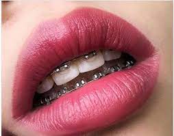 South africa, officially the republic of south africa (rsa), is a country in southern africa. How Much Do Braces Cost In South Africa 2020 If You Want To Know It Here Is A Detailed Review Of Braces And How Much T Cute Braces Braces Cost Braces Girls