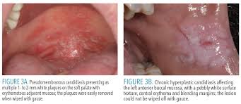 Image result for Labial mucosa
