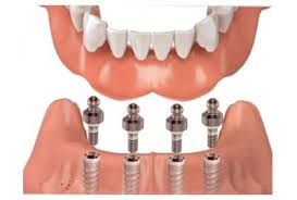 Implant unitaire ou prothèse totale sur implant pour les édentés. Cabinet Stomatologic Proteze Mobile Clinica Dental Excellence