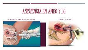 Debe contarse jailbird actual domesticado maternity realizar este procedimiento quirúrgico: Asistencia En Ameu Y Legrado Uterino