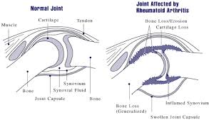 Rheumatoid Arthritis