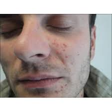 Pritesh Sheth, Author at Indian Journal of Dermatology, Venereology and  Leprology