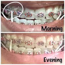 Latest Teeth Braces Colors Ideas Cute Girl Teeth Braces Braces Colors Dental Braces Colors