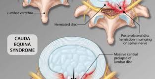 Cauda equina syndrome refers to a collection of symptoms and signs that result from. Index Of Wp Content Uploads 2017 07