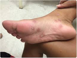 Image result for syphilis symptoms
