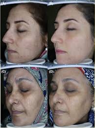 Evaluation of effectiveness of tranexamic acid as mesotherapy in  improvement of periorbital wrinkling in a trial study