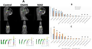 We did not find results for: Mandibular Advancement Devices Prevent The Adverse Cardiac Effects Of Obstructive Sleep Apnea Hypopnea Syndrome Osahs Scientific Reports