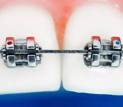 Moving teeth is a medical procedure that should be done with the supervision of a licensed professional. Why Did My Braces Brackets Fall Off South Surrey Smiles