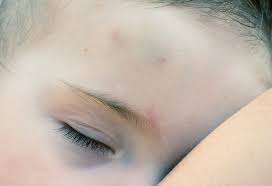 Moist heat sinks deeply into the bruise and also spreads fast. Bruises In Infants Causes Treatment Preventive Measures