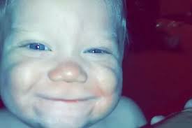 Baby smiles for first time after life-changing operations to fix huge  tongue that permanently sticks out