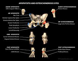 It provides attachment for the inguinal ligament , the sartorius muscle , 1 4 and the tensor fasciae latae muscle. Hip Apophysitis