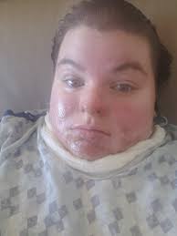 Surviving severe leg burns during pregnancy