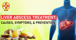 Image result for Liver Abscess