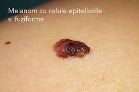 Semnele si simptomele cancerului de piele factorii de risc ai cancerului de piele diagnosticul cancerul de piele este o tumora maligna a celulelor ce alcatuiesc pielea. Melanom Malign Tumora Maligna De Piele Tratament Si Remediu Corect