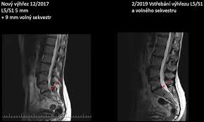 Image result for vyhřezlá ploténka