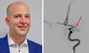 Thrombektomie: Deutschland nimmt Vorreiterrolle ein •  healthcare-in-europe.com