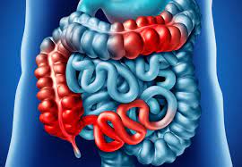 Continuity Of Care In A Teenage Patient With Stricturing Crohn S Disease Consult Qd