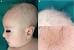 Menkes Disease In Adults