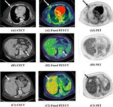 However, the risk from any one scan is small. Role Of Positron Emission Tomography Computed Tomography Pet Ct In Breast Cancer Egyptian Journal Of Radiology And Nuclear Medicine Full Text