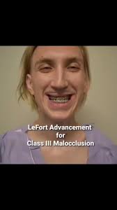 LeFort Advancement ** Cute cleft babies turn into strong cleft teenagers  who sometimes need jaw surgery or a LeFort Advancement. I like to spend  extra time planning the complicated surgery in 3D ...
