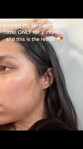 Loose Skin Before and After Witch Hazel