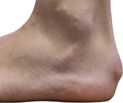 Pijnlijke Achillespees Hielpijncentrum