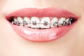 While placing the brackets the orthodontist makes the wearer bite to check if the brackets are coming in way of the bite. Braces Are Peeling Off Reasons How To Fix Them Back Recommendations Of Dentists