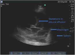 Image result for Parapneumonic Effusion