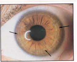 Image result for stress ring iridology