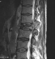 We did not find results for: Lymphoma Radiology Reference Article Radiopaedia Org