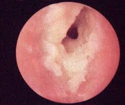 Image result for Acute Otitis Externa