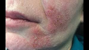 Its acidity can help break up plaque and kill bacteria in your mouth. How To Get Rid Of Sebaceous Hyperplasia Youtube