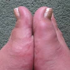 Pin On Gout Causes