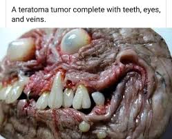 Check spelling or type a new query. Cysts With Teeth And Hair Photos Teethwalls