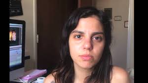 De repente, os músculos faciais enfraquecem, em geral, em horas. Paralisia Facial Periferica Ou Paralisia De Bell Meia Face