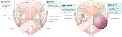 Endometriosis is located near the bowels, the bladder, the appendix, in the liver or the lungs. Diagnosis Nuffield Department Of Women S Reproductive Health