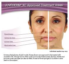 Plus you get 5 units of botox for chin free. Fillers Juvederm Ultra Plus Ultra Voluma Vollure Volbella Belotero