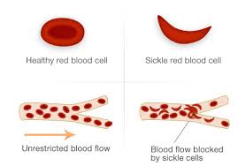 Comment what you think currently streaming on omlet.gg/hamcryhyper twitter:@codyyyraze instagram:@codyyyraze discord: Sickle Cell Disease Tif