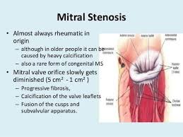 This abnormal valve doesn't open properly, blocking blood flow coming into your left. Mitral Stenosis Science Of Medicine Facebook