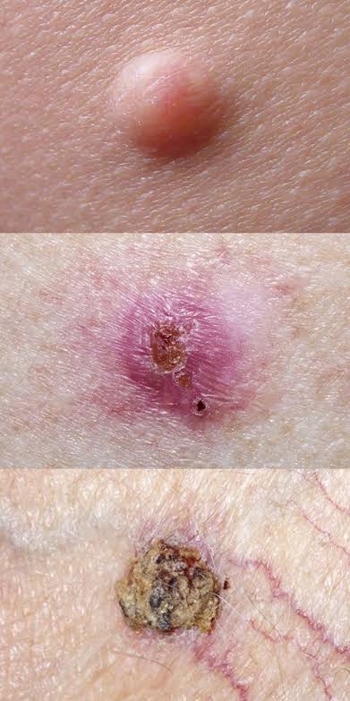Basal Cell Carcinoma (BCC) Skin Cancer Risk Factors & Treatment | Saint  John's Cancer Institute